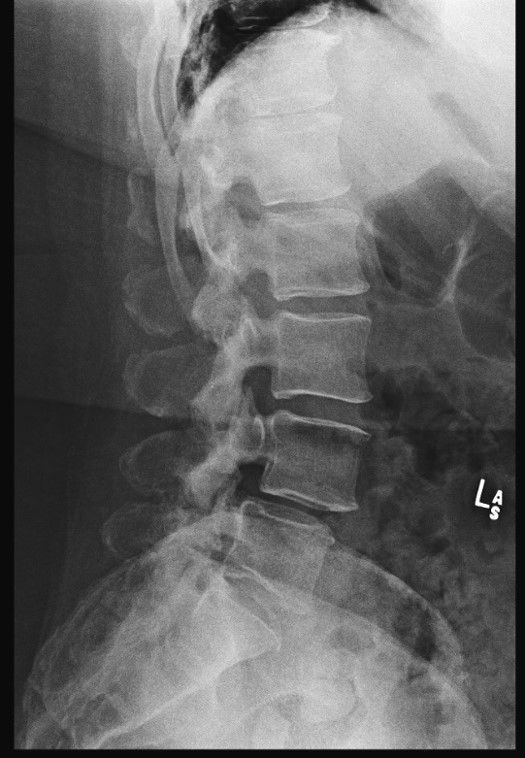 Lumbar Laminectomy for Synovial Cyst - cns.org